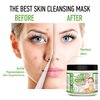 Indian Healing Clay/Natural Bentonite Clay/Detoxifying Wyoming Clay/Deep Pore Cleansing Mask, Face Skin Care, Acne Remover/With Bowl and Spatula