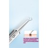 Professional Facial Blackhead Remover Tweezers,Extractor Acne Removal Kit Pimple Popper Tool, Clip for Whiteheads, Acne Clip, Ingrown Hairs Tweezers, Blackheads Remover Extractor, Stainless Steel