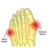 CYG&CL Bunion Corrector and Bunion Pain Relief Sleeves Toe Protector with Gel Toe Spacers, Built-in Soft Silicone Pads for Big Toe Straighten, Hallux Valgus, Hammer Toe for Day and Night Use