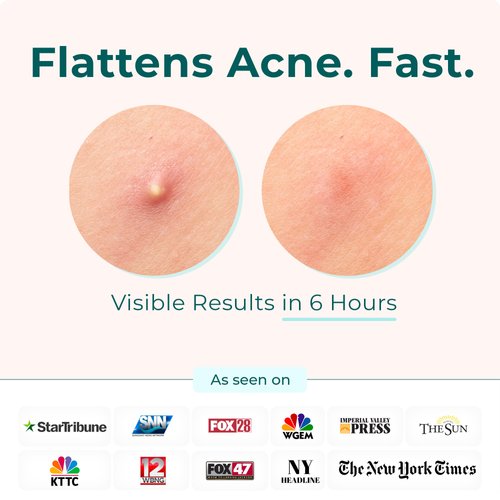 CLEOF Pimple Patches for Face & Body - Overnight Treatment - Acne Patch for Zits, Dots, Bumps, Spots, Pimples, Whiteheads - Hydrocolloid Stickers - Vegan, Cruelty-Free, Hypoallergenic (10mm)