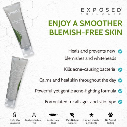 Exposed Skin Care Acne Treatment Serum Step 3 – Quickly Reduces Pimple Size and Redness - 12 Hour Spot Treatment - 3.5% Benzoyl Peroxide, Natural Green Tea & Tea Tree Oil
