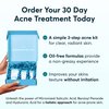 MDacne 3 Step Benzoyl Peroxide Acne Treatment Kit - Benzoyl Peroxide Cream 2.5%, Salicylic Acid Cleanser, Niacinamide Moisturizer – Medicated Plant-Based Kit for Adult & Teen Acne, 30 Day Acne Kit