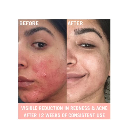 Mudita Earth Pineapple and Rosehip Vitamin C and Niacinamide Serum - Organic Vitamin C E Ferulic Serum for Acne Scars Dark Spots - Hyperpigmentation Serum for Skin Brightening and Rejuvenation