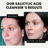 𝗪𝗜𝗡𝗡𝗘𝗥 𝟮𝟬𝟮𝟯* Salicylic Acid Foaming Cleanser - Unclogs Pores, Prevents Pimple Breakouts - 3X Clearer Skin with Niacinamide, Vitamin E and Green Tea - 5.1 oz/150 ml