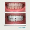 Expertwhite Extreme 44% Teeth Whitening Gel (6-gels)