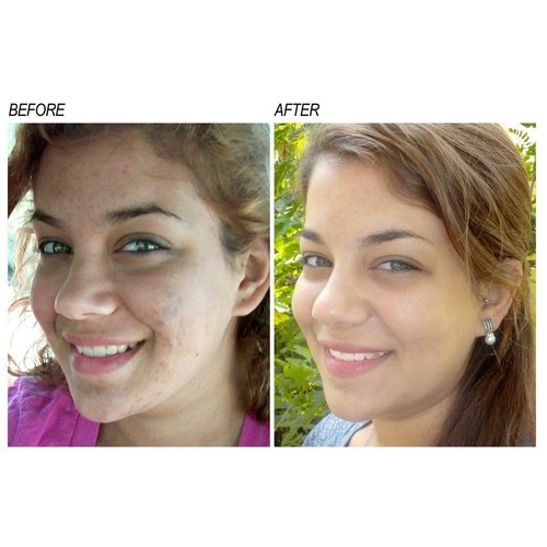 Neoprosone, Vitamin C Serum for Face | 1 Fl oz / 30ml | Brightening Serum For Dark Circle, Wrinkles | with Alpha Arbutin and Castor Oil