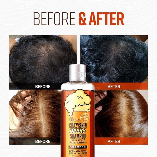 CRAZY SKIN German Beers Shampoo - BIOTIN shampoo for hair loss, Rich with Beer Yeast for Hair Regrowth and Thickening, thinning hair, Sulfate/Chemical free 20.30 fl oz(300ml) X 2set