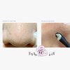 ilso Natural Mild Clear Nose Patch, Melt blackheads & Tighten Pores, no irritation, Sensitive skin friendly, Korean skincare, cotton swabs included, 5 sheets (Esther Bunny Limited Edition)