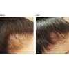 Infinix Scalp & Hair Treatment Pack-Black Seed Oil-Thick and Full & Biotin Infused-Finishing, Repair and Soothing - For irritated, Itchy Scalp - For Hair growth - Pack of 2