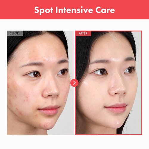 TOSOWOONG SOS Intensive RED Clinic Ovalicin Skin Clear Cream, Acne Treatment and Skin Inflammation Cream, Moisturizing Cream with Niacinamide and Sulfur, Korean Skincare, 50g, 1.76 oz.