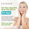 Exposed Skin Care Clearing Tonic Facial Toner with 1% Salicylic Acid and Witch Hazel for Acne Treatment – Pore Minimizing Toner to Prevent Breakouts, Reduce Redness and Balance Skin – Step 2 (4 fl oz)