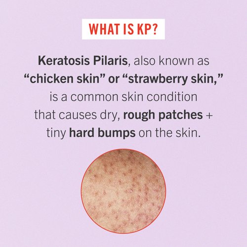 First Aid Beauty Bye Bye Bumps Kit – 3 Exfoliating Favorites – KP Bump Eraser Body Scrub with 10% AHA, 4 oz, KP Smoothing Body Lotion, 1 oz, + Ingrown Hair Pads, 28 Count