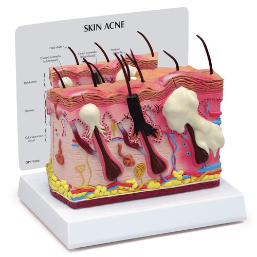 GPI Anatomicals - Skin Acne Model, Cross-Section Showing Normal and Common Acne-Riddled Skin for Human Anatomy, Physiology Education, Anatomy Model for Doctor's Office, Medical Learning Resources