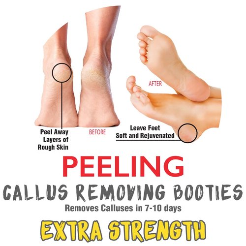 Onyx Professional Foot Peel Mask Callus Remover (2 Pack) Dead Skin Remover, Foot Exfoliator, Cracked Heel Repair - Feet Peeling Mask Pedicure Kit For Smooth Baby Soft Healthy Feet