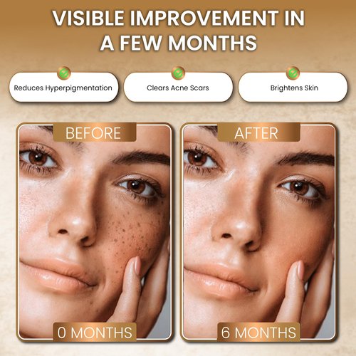 RB REHANA BEAUTY Kojic Acid Soap for Hyperpigmentation, Dark Spot Remover for Body & Face, Acne Cleanser, Lemon Turmeric Brightening Soap with Vitamin C (3x100g Bars + 2 Nets), For both Women & Men