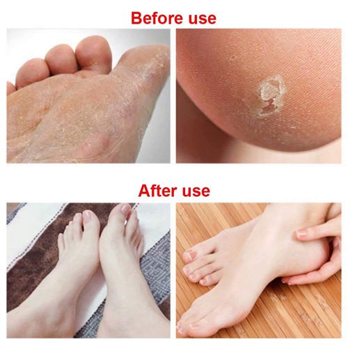Paddsun 6Pcs Foot File Callus Remover Replacement Blades Pedicure Rasp Detachable Foot Scrubber Hard Skin Remove Stainless Steel Big Hole for Wet and Dry Feet