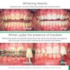 Opalescence Teeth Whitening Bundle - Opalescence Go 15% Hydrogen Peroxide Prefilled Trays (10 Trearments) and Sensitive Whitening Toothpaste 4.7 Onz - Mint Flavor 5194-5167