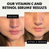 Eclat Skincare Face Serum Set - Vitamin C Serum for Radiance, Retinol Serum for Wrinkles