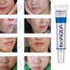 BioAqua Face Skin Care Acne Treatment Removal Scar Blemish Marks Cream