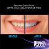 DentaPro 2000 3D Teeth Whitening Kit – Deluxe Addition Includes LED Light, (2) 5ml Gel Syringes, Custom Moldable Tray (2), Vitamin E Swab (2), Shade Guide – See Results After Just One Use!