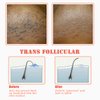 TailaiMei Exfoliating Brush for Ingrown Hair Treatment - To Treat and Prevent Bikini Bumps, Razor Bumps - Silky Smooth Skin Solution for Men and Women(Orange)