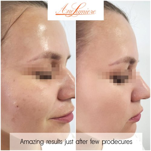 Ane Lumiere V Peel Glycolic Acid Chemical Peel 1.69oz AHA BHA Skin Peel with Phenol Vitamin C Almond Glycolic Salicylic Phytic Ferulic Retinol acids for face