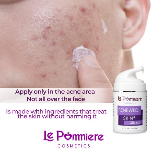 Le Pommiere Anti Acne Treatment Cream, Remove Pimples on Face and Body. Teenager, youth, adult, hormonal or cystic