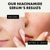 Niacinamide Serum for Face - Pore Minimizer for Face with Hyaluronic Acid - Acne Serum + Acne Dark Spot Remover for Face - Serum Niacinimide Personal Care Products
