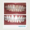 Expertwhite Extreme 44% Teeth Whitening Gel (6-gels)