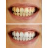 Teeth Whitening Gel 44% Syringes Carbamide Peroxide 20 Tooth Bleaching Gel 3ml Dispensers