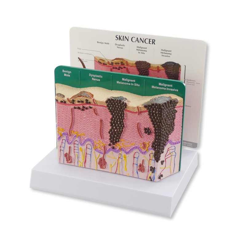 GPI Anatomicals - Skin Cancer Model, Skin Replica with Melanoma and ...