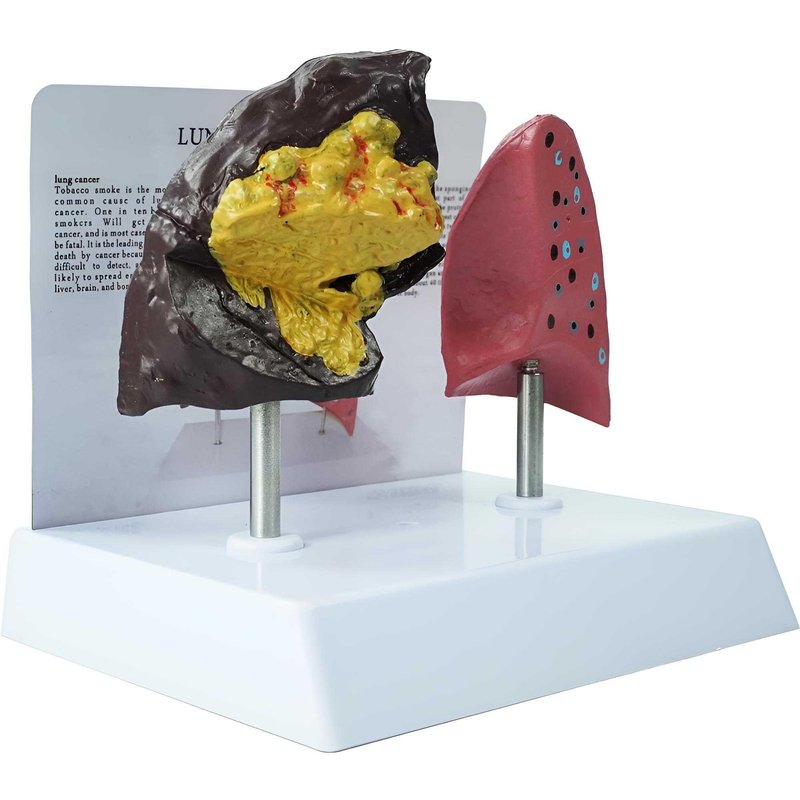 SKUWGW Smoker's Lung vs Healthy Lung Comparative Model - Life Size ...