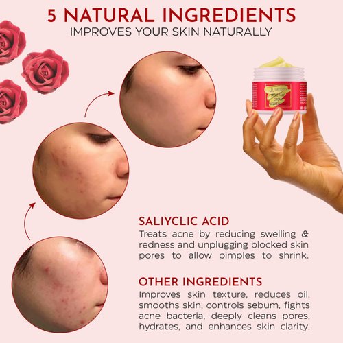 Acne Face Cream, Salicylic Acid Cystic Acne Treatment For Face, Back But, Acne Spot Treatment for Face and Body Pimple, Acne Treatment Cream, Anti-Acne Skincare Cream for Teens & Adults, 3.53 OZ