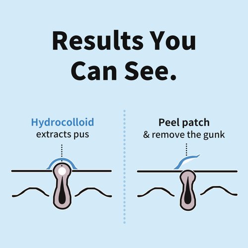 Acne Patches 36 Patches (2 Sizes), Acne Medical-Grade Hydrocolloid Acne Patches for Face Invisible Pimple Patches Sticker with Absorbing Cover for Acne Treatment for All Skin Types