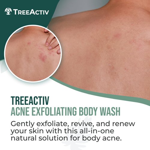 TreeActiv Acne Exfoliating Body Wash, 8oz, Foam Cleanser for All Skin Types, Sulfur, Aloe Vera, Jojoba Beads