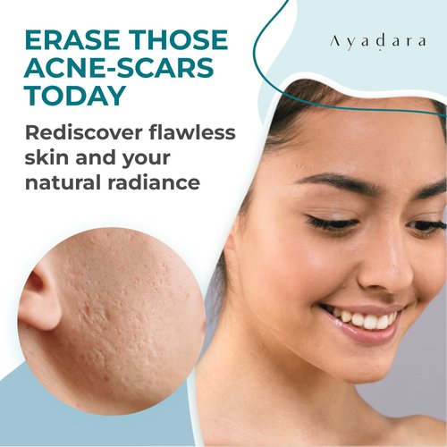 Ayadara Acne Scar Healing Cream, 2 fl oz, Acne Scar Treatment for Face, Stretch Marks, Body Scars, Acne Scar Removal Cream for Body, Acne Scar Remover for Cuts and Burns, For All Skin Types, 200+ Uses