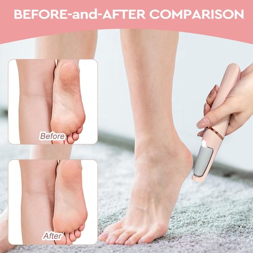 Nuve Smooth Pedicure Wand, Electric Callus Remover for Feet, Portable Smooth Pedicure Stick, Callus Removal Tool, Waterproof, for Treating Dry Cracked Heels, Calluses and Dead Skin.