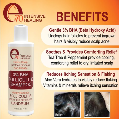 Folliculitis Treatment Clarifying Shampoo with Salicylic Acid to Remove Build Up, For Normal to Oily Scalp. Prone to Folliculitis, Dandruff, Itchy & Flaky Scalp, Seborrheic Dermatitis Paraben-Free.