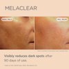 ISDIN Melaclear, Dark Spot Correcting Serum with Vitamin C and Phytic Acid, Suitable for Sensitive Skin…