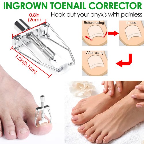 Ingrown Toenail Removal Kit, Ingrown Toenail Tool for Ingrown & Thick Nail Treatment Relieves Toenail Pain, with Correction Clippers, Corrector Strips, Corrector Patch, File, Lifter Pedicure (8pcs)