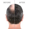 Hair-Regen Advanced 5% Minoxidil Hair Regrowth Treatment for Thinning Hair and Hair Loss for Men - 6 Month Supply, Hair Loss Treatment, Minoxidil Topical Solution So Thicker Fuller Hair Keeps Growing