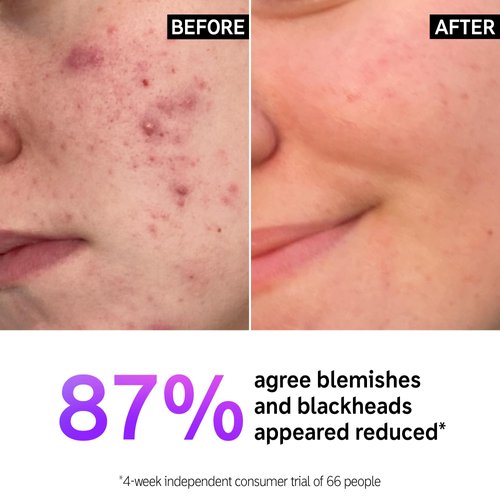 The INKEY List Salicylic Acid Cleanser, Face Wash for Blemishes, Blackheads, Oily Skin and Breakouts, Non-Drying Facial Cleanser Safe for All Skin Types, 5.0 fl oz