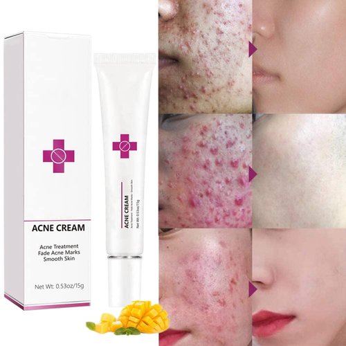 Acne Cream Pimple Cream for Face, Oil Control Pimple Remover Cream Get Rid of Pimples Fast,for Oily and Acne Prone Skin, Cruelty Free, Crema para espinillas en la cara