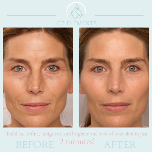 Ice Elements 2 Minute Miracle Gel | 1.7oz | Face Exfoliator | Hydrating, Pore Minimizer, & Clarifying Skin Care | Made With Green Tea and Ginger | Vitamin C and A | Skin Treatment and Makeup Prep