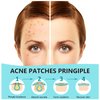Pimple Patches for Face 180 Counts Hydrocolloid Acne Patches for face Invisible Zit Patches Acne Spot Treatment/Blemish Patches Cover Patches Stickers