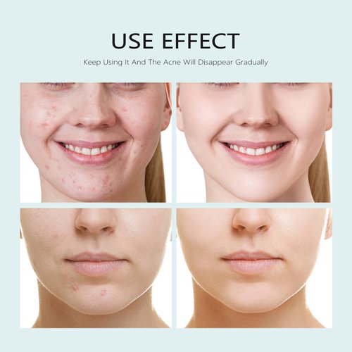 Facial Mask Anti Acne Face Masks Skin Care, Sheet Masks With Salicylic Acid Sheet For Acne Prone Hydrating Moisturizing Skincare for Scar Breakouts Pimple Beauty Oil Control Redness 10 Sheets