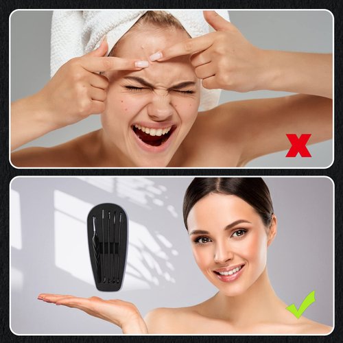 FVION Blackhead and Acne Extractor Kit, Professional Pimple Popper Tool Kit, Acne Tweezers and Blackhead Remover Tools for Face, 5 PCS Surgical Extractor Pimple Popping Tools