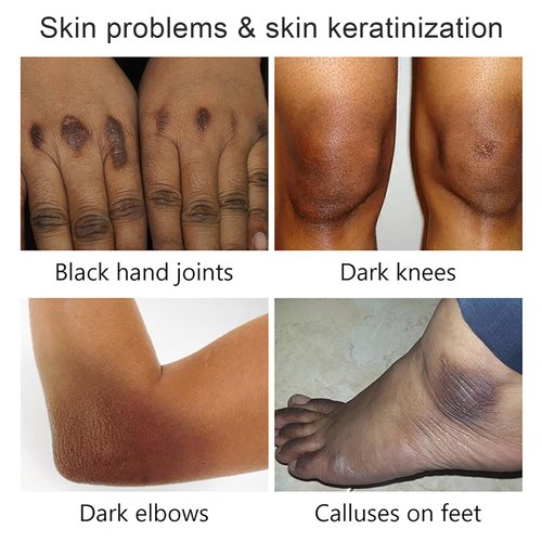 Yellow Peeling Oil, Exfoliating Chemical Peel At Home for Hand, Body and Foot Peel, Extra Strong Exfoliant Peeling Oil for Dark Skin Extra Strength All Skin Type 3.38 Fl Oz