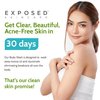 Exposed Skin Care Body Wash - Back and Body Acne Wash with Salicylic Acid and Tea Tree Oil – Exfoliating Bacne Treatment for Clearer, Healthier Skin – Body Cleanser for All Skin Types (12 fl oz)