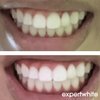 Expertwhite 22% Carbamide Peroxide Professional Dental-Grade Teeth Whitening Gel Refills for Trays - Made in USA. Peróxido de carbamida whitening gel retainer whitening gel